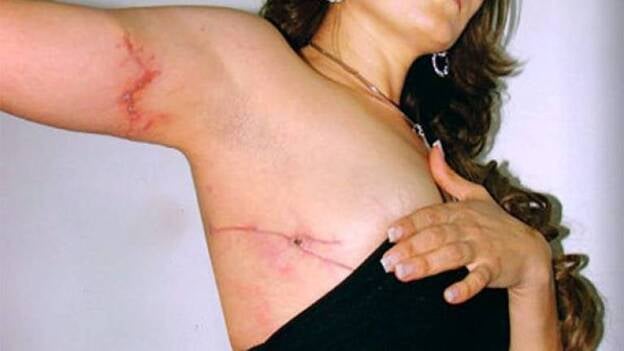 Alcaldesa muestra cuerpo herido en atentados para decir que sigue al frente