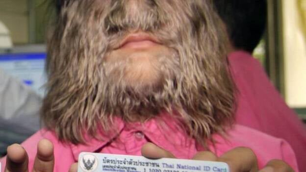 La 'niña más peluda del mundo'