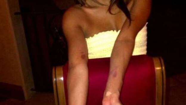 Eva Longoria enseña en Twitter sus heridas de guerra