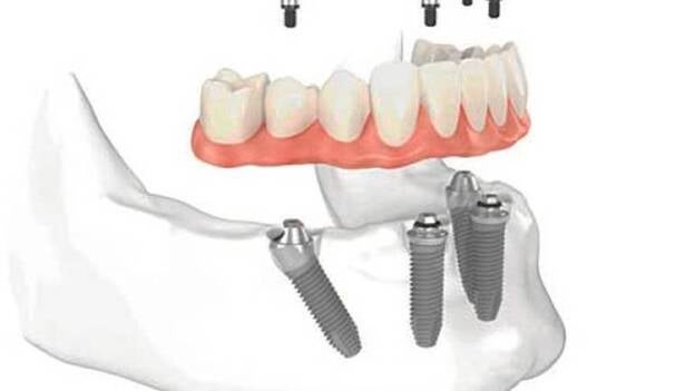 Prótesis completa sobre implantes