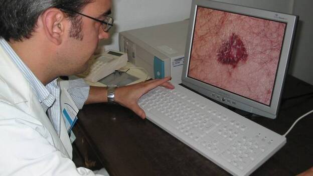 El Hospital Dr. Negrín detecta cada año unos 70 nuevos casos de cáncer de piel