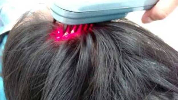 Un láser de baja intensidad para solucionar los problemas de caída de pelo