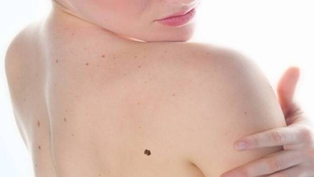 El 43% de los españoles nunca ha acudido al dermatólogo para hacerse una revisión de sus lunares