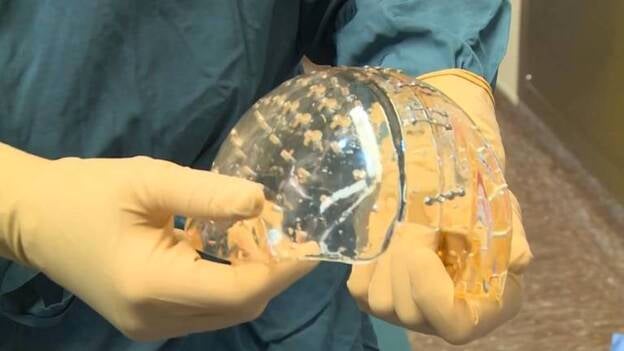 Trasplantan un cráneo impreso en 3D a una niña con hidrocefalia