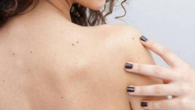 El número de lunares del brazo puede alertar de cáncer de piel