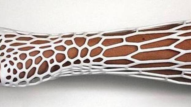 La impresión 3D, la alternativa a las escayolas tradicionales que ya se utiliza de manera habitual