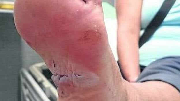 Otra bañista fue mordida por un tiburón en agosto en Playa del Inglés