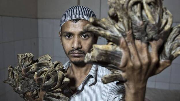 El "hombre árbol" de Bangladesh supera con éxito su primera operación