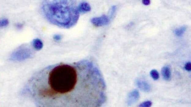 Un nuevo estudio examina cambios genéticos relacionados con la enfermedad de Parkinson