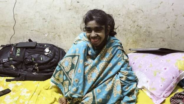 La ciencia, última esperanza para la "niña lobo" de Bangladesh