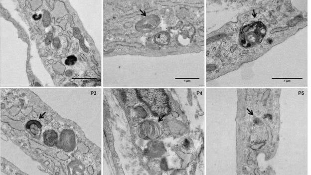 Describen un aumento del estrés oxidativo en las enfermedades metabólicas hereditarias
