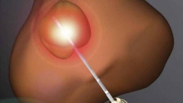 La ablación por láser, cada vez más viable como tratamiento para el cáncer de próstata