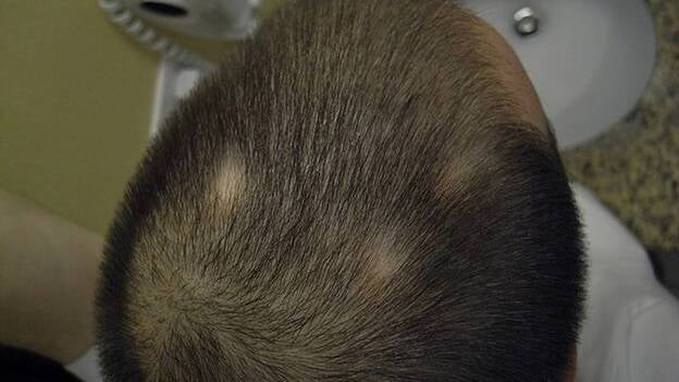 La piel del cuero cabelludo es más propensa a las quemaduras con las exposiciones solares