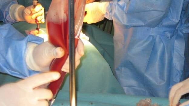 España supera los 230.000 donantes de médula ósea en los seis primeros meses del año