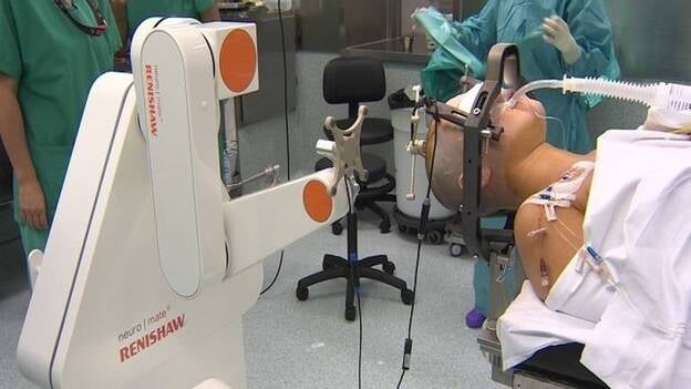 Una operación pionera con robot consigue curar la epilepsia al 80% de los pacientes