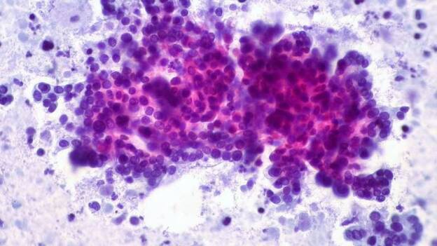 Investigadores estudian una nueva generación de fármacos para prevenir el cáncer y el Alzheimer