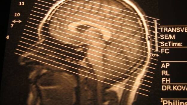 Desarrollan un dispositivo que detecta un ataque epiléptico inminente y la dosis de fármaco que lo detendrá