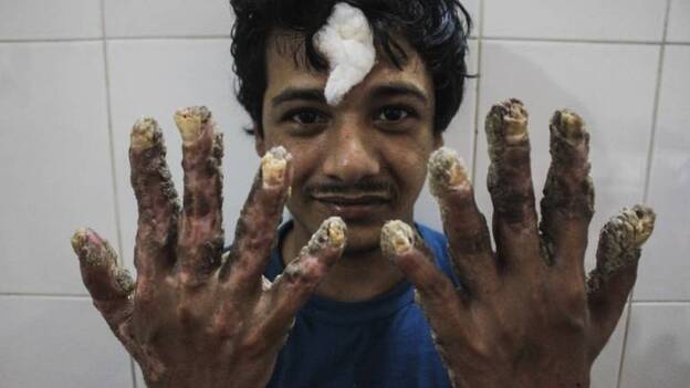 El hombre árbol de Bangladesh atisba ya el día en que volverá a ser normal