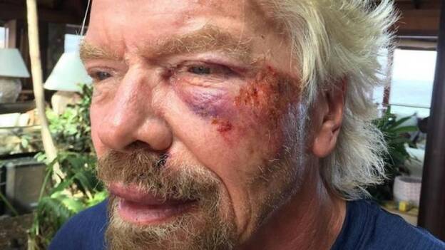 Branson sufre un accidente de bicicleta durante sus vacaciones