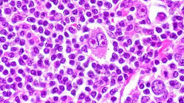 La falta de oncólogos especializados retrasa el inicio del tratamiento del linfoma en España