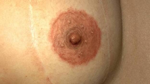Ya es posible 'recuperar' la areola de la mama tras una mastectomía gracias a la técnica de micropigmentación