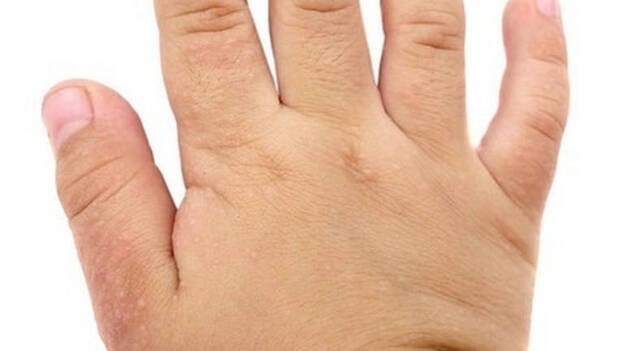 Experto alerta del incremento de la prevalencia de dermatitis atópica