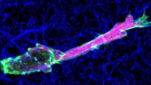 Descubren por qué las células tumorales se mueven de forma distinta a las sanas