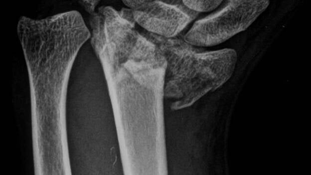Un experto avisa de que se están diagnosticando y tratando inadecuadamente las fracturas de radio