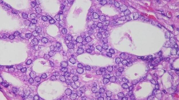 Descubren una nueva vía para combatir el cáncer de próstata resistente