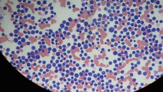 Investigadores abren la puerta a nuevos tratamientos con la identificación de las principales mutaciones de la leucemia