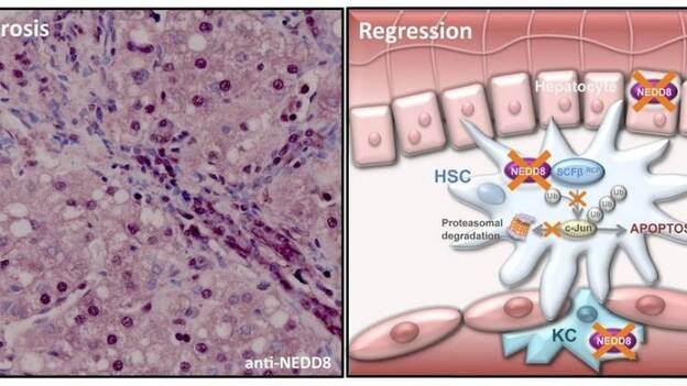 Científicos españoles describen un nuevo mecanismo de progresión y regresión de la fibrosis del hígado