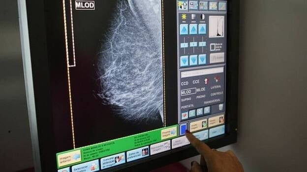 Investigadores españoles descubren nuevas alteraciones génicas en uno de los tipos más agresivos del cáncer de mama