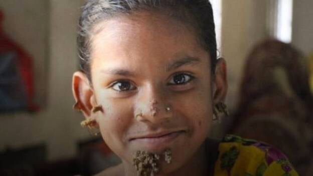 Diagnostican a una niña en Bangladesh la enfermedad del "hombre árbol"