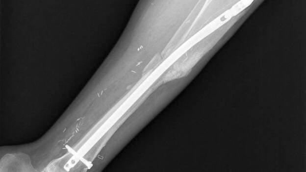 España lidera una investigación europea para comprobar el beneficio de las células madre en la regeneración ósea