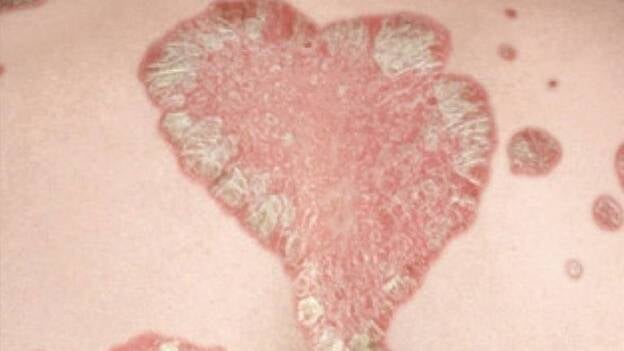 Un nuevo medicamento biológico aclara casi totalmente las placas de psoriasis