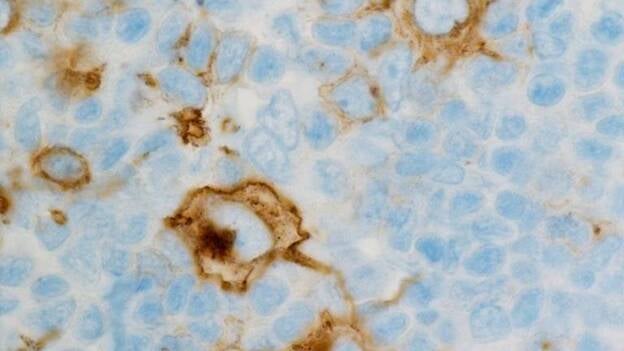 Oncólogos expertos en linfomas piden que se multipliquen esfuerzos para un mejor diagnóstico y tratamiento