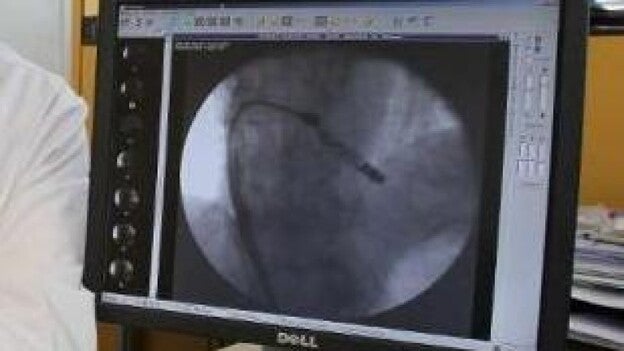 El HUC implanta un marcapasos diez veces más pequeño que el convencional