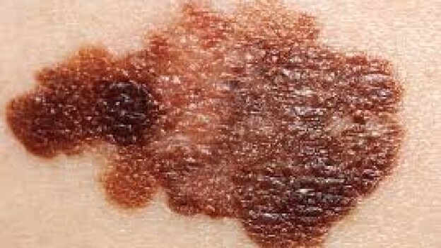 Cada año aumenta un 10 % la incidencia del melanoma en España