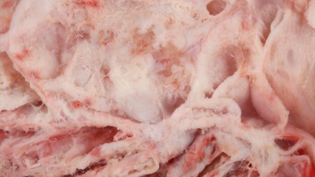 Logran frenar la progresión del cáncer de ovario recurrente