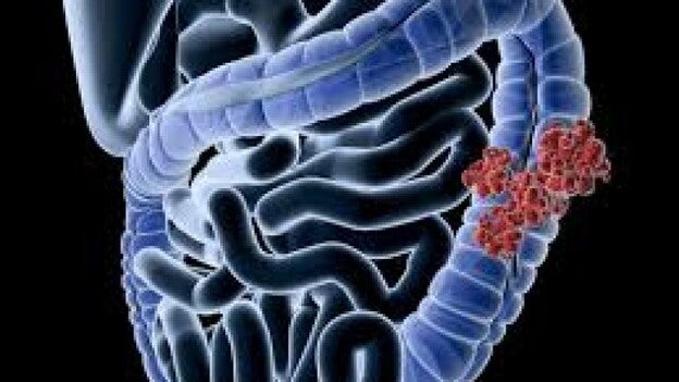 La detección precoz de cáncer colon debería empezar a 45 años