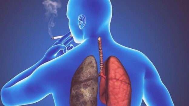 En los dos últimos años ha habido más avances en cáncer de pulmón