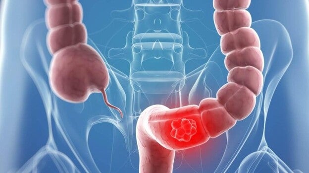 Detectar a tiempo el cáncer de colon cuesta 182 euros