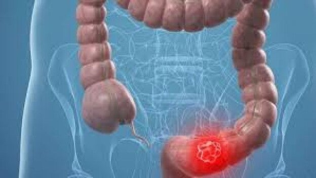Cada día se diagnostican 94 casos de cáncer de colon