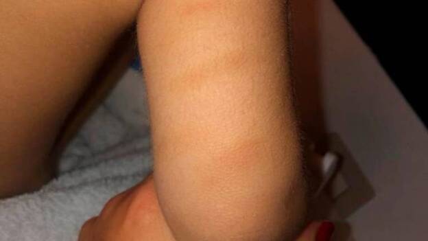 Las imagénes de las lesiones que se investigan en la guardería de Telde