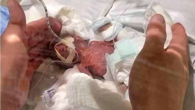 Dan de alta al bebé más pequeño del mundo