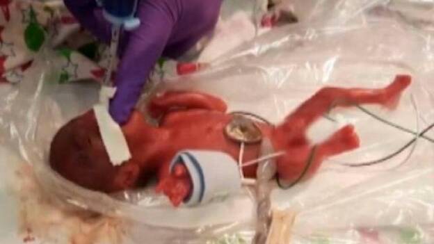 Saybie, la bebé que sobrevivió con 245 gramos