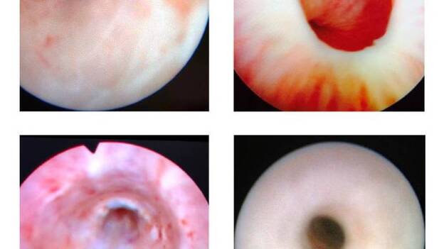 Estenosis de uretra, un problema más frecuente de lo que suponemos
