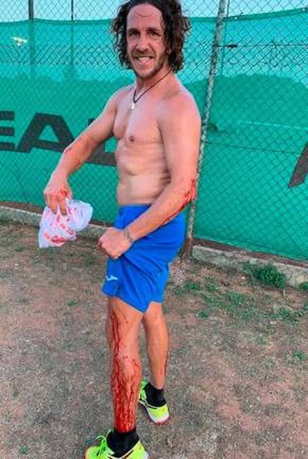 Carles Puyol, su accidente durante las vacaciones