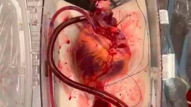 Logran revivir un corazón que ya no latía