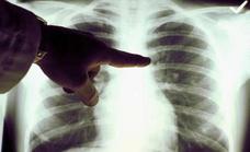 El cáncer de pulmón: frecuente y mortal